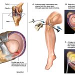 phẫu thuật rách sụn