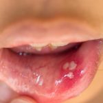 Hình ảnh HPV trong miệng