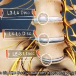 vị trí thoát vị đĩa đệm cột sống thắt lưng