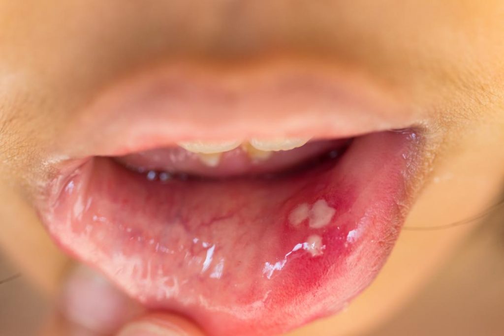 Hình ảnh HPV trong miệng