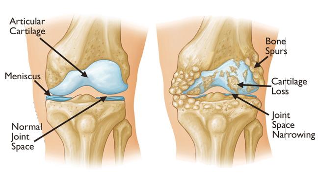 Thoái hoá khớp gối