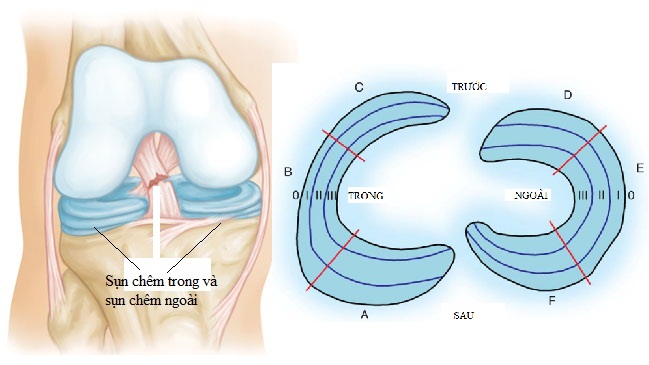 tổn thương sụn