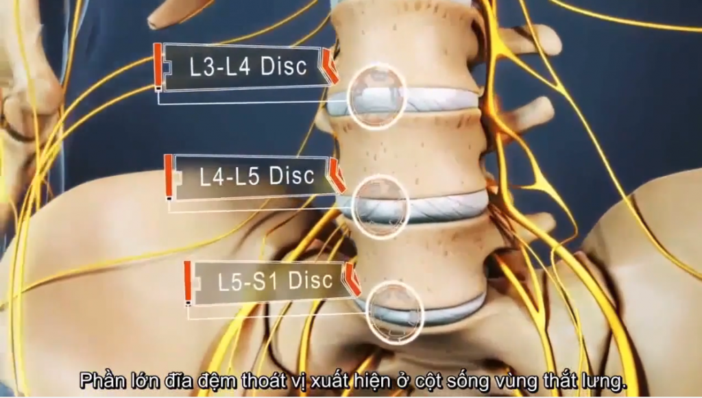 vị trí thoát vị đĩa đệm cột sống thắt lưng